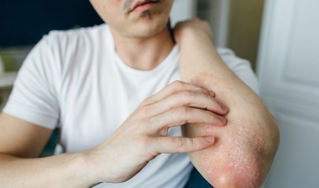 Tips & Tricks to Use Coconut Oil for Eczema